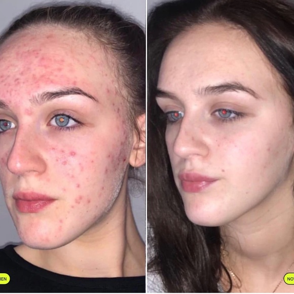 Carbon Theory Anti-Breakout Facial Cleansing Bar - Picture 8 of 8